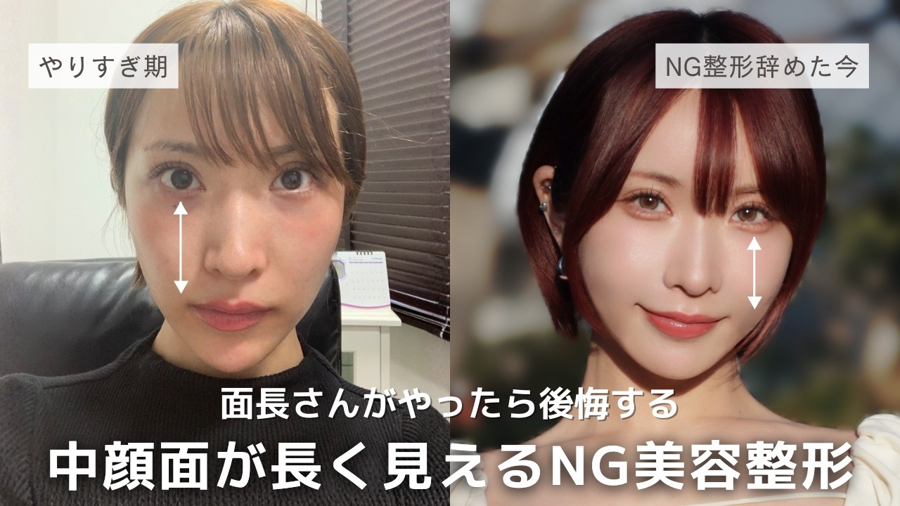 やる前に絶対知ってほしい中顔面が長く見えた整形6つ