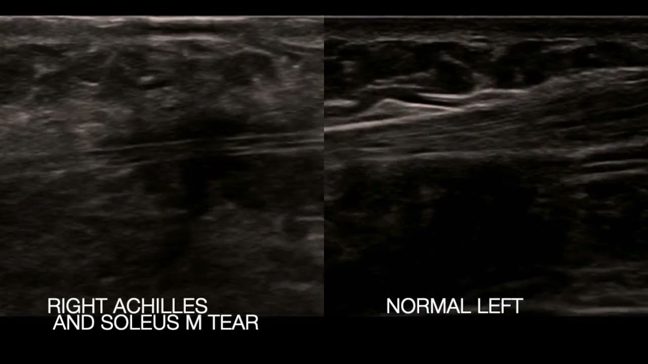 PoCUS Evaluation of Achilles Tendon Injury: 16 y.o. Soccer Player with Right Heel Pain