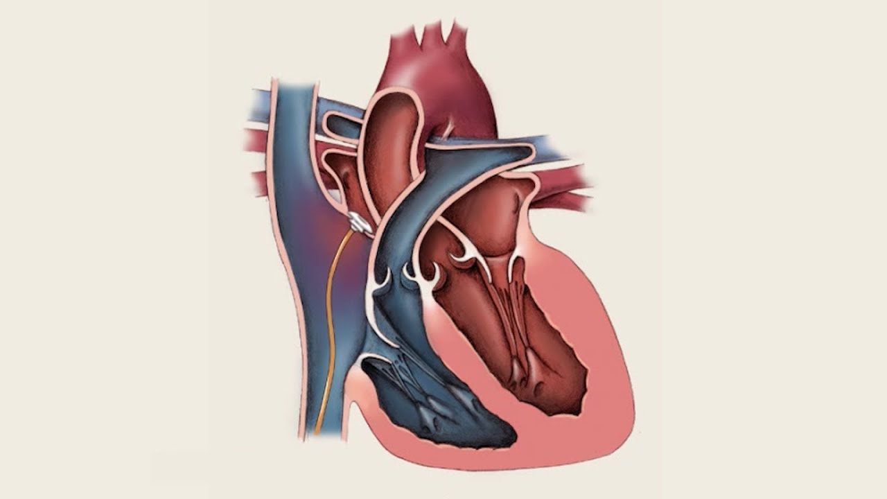 Mayo Clinic Minute: What you need to know about patent foramen ovale