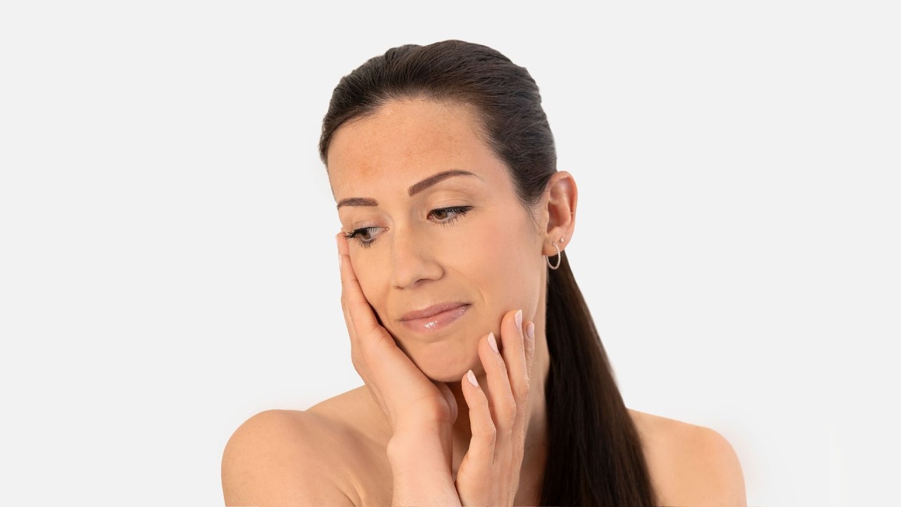 Melasma