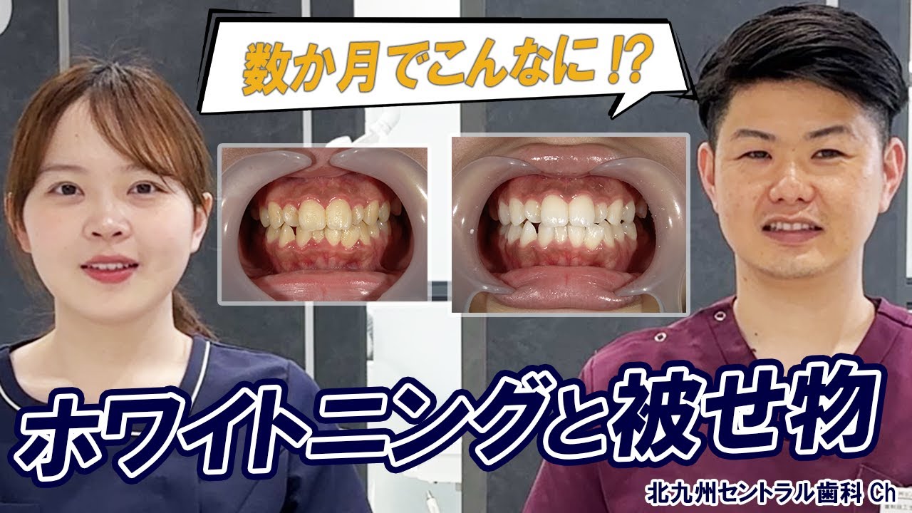 【白い歯】ホワイトニング＋被せ物・詰め物ビフォーアフター