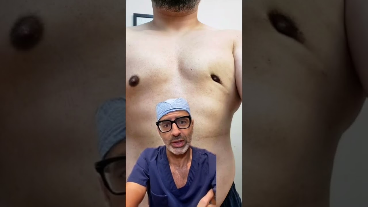 Cratering happens if you take too much fat out #malechest  #gynecomastia #gyno #gynecomastiasugrery