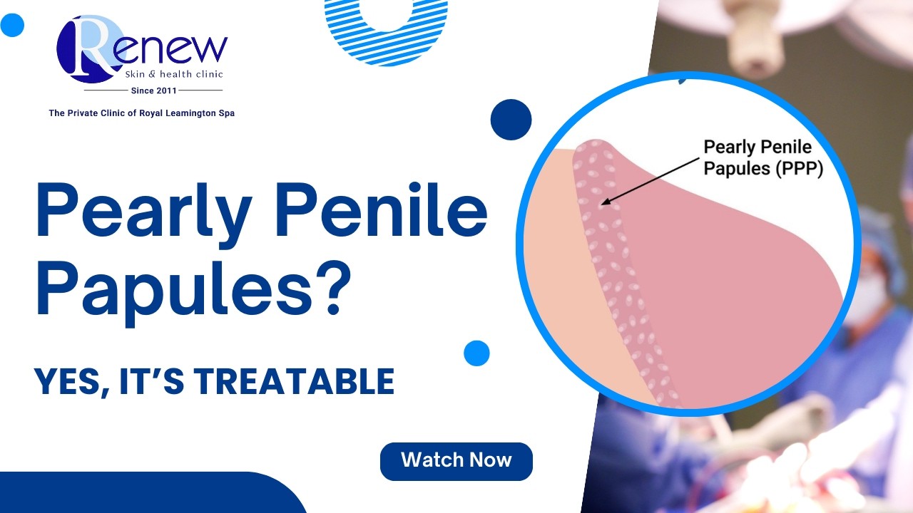 Pearly Penile Papules? Yes, It&rsquo;s Treatable | Causes & Treatment Explained
