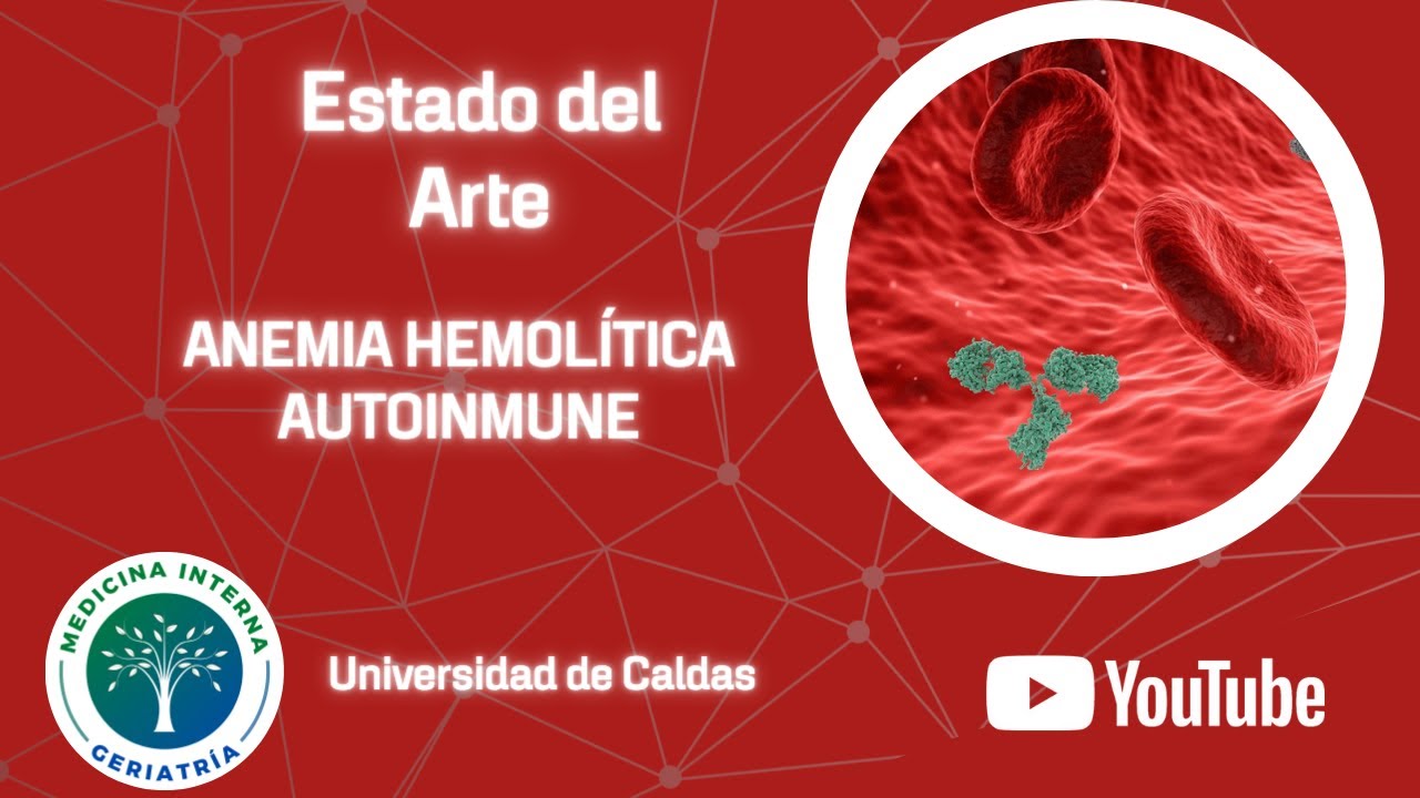 Anemia hemolítica autoinmune.