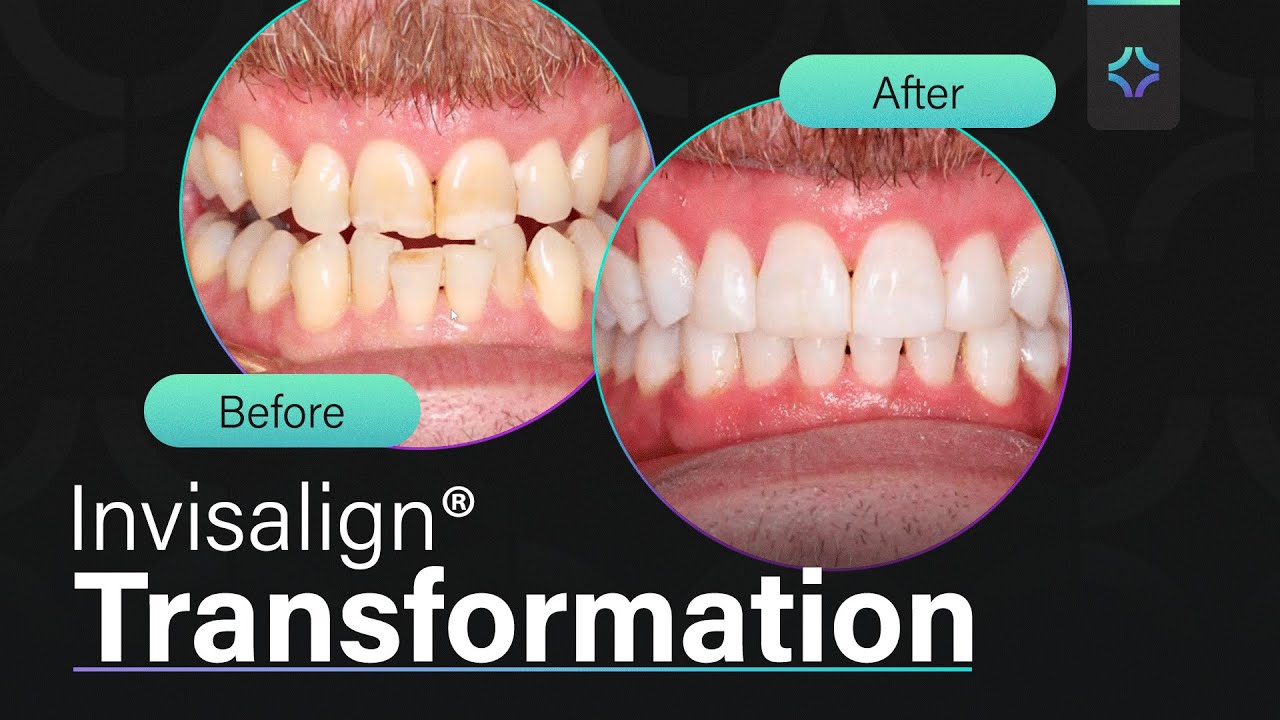 LIFE CHANGING Teeth Restoration! Impossible Transformation Solved with Invisalign&reg;! - Ep.3