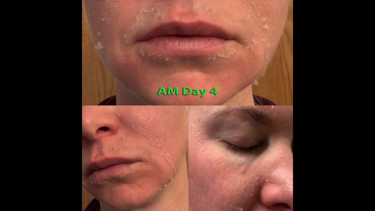 Day by Day Progress (How skin looks while recovering from a superficial skin peel)