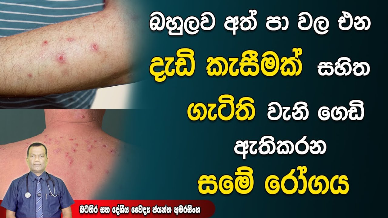 බහුලව අත් කකුල් මත ඇතිවන දැඩි කැසීමක් සහිත ගැටිති වැනි ගෙඩි එන විශේෂිත සමේ රෝගය Prurigo Nodularis