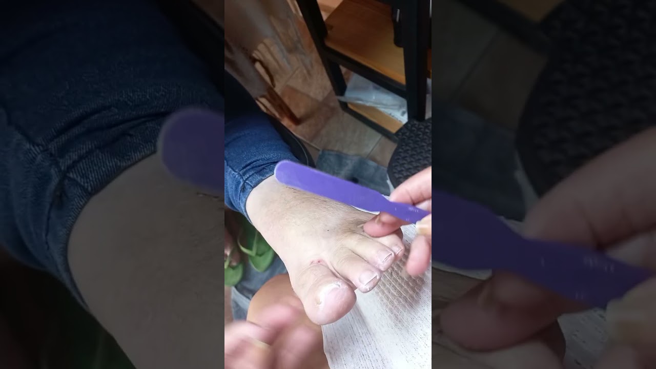 Essa cliente sempre reclama de dor nos cantinhos do dedão 