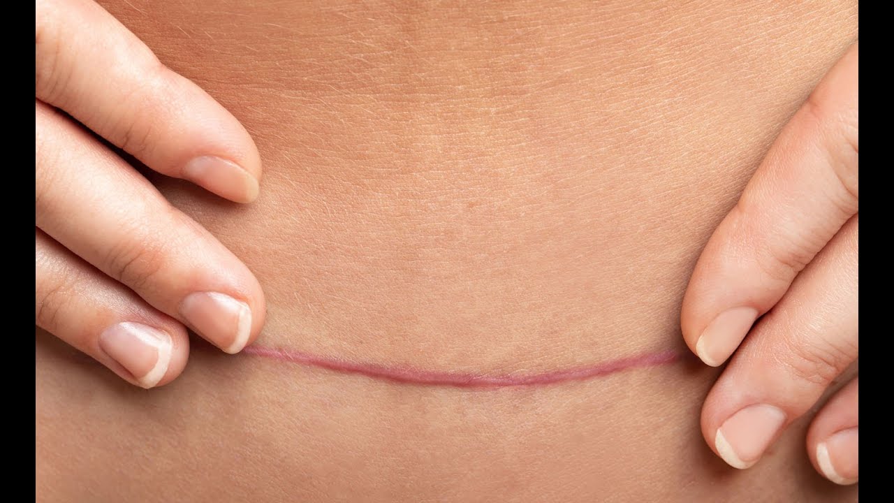 Tout savoir sur la césarienne (mon expérience)