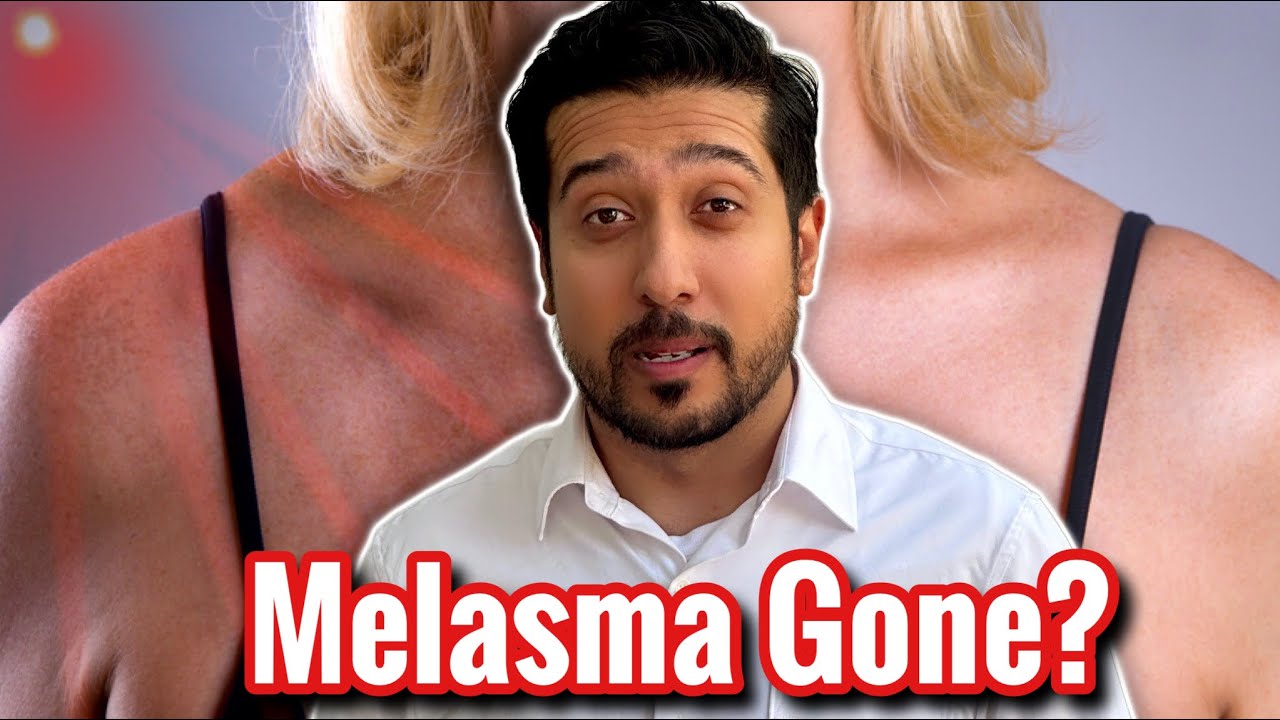 Erase Melasma with Red Light Therapy? What Dermatologists Won’t Tell You