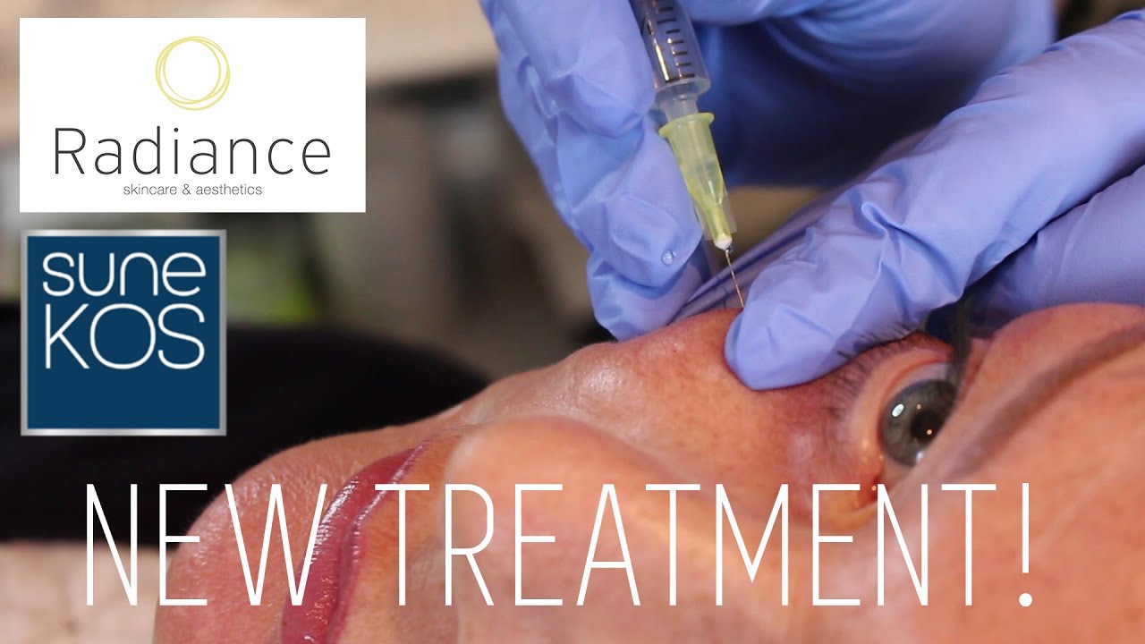 NEW TREATMENT! | RADIANCE SKINCARE & AESTHETICS | SUNEKOS!