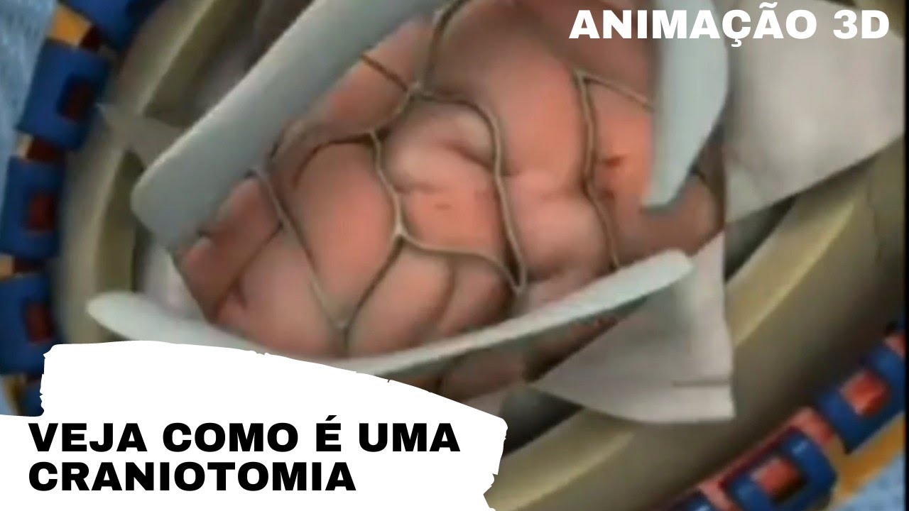 Veja como &eacute; uma Craniotomia em 3D | Neurologia | Medicina Geral