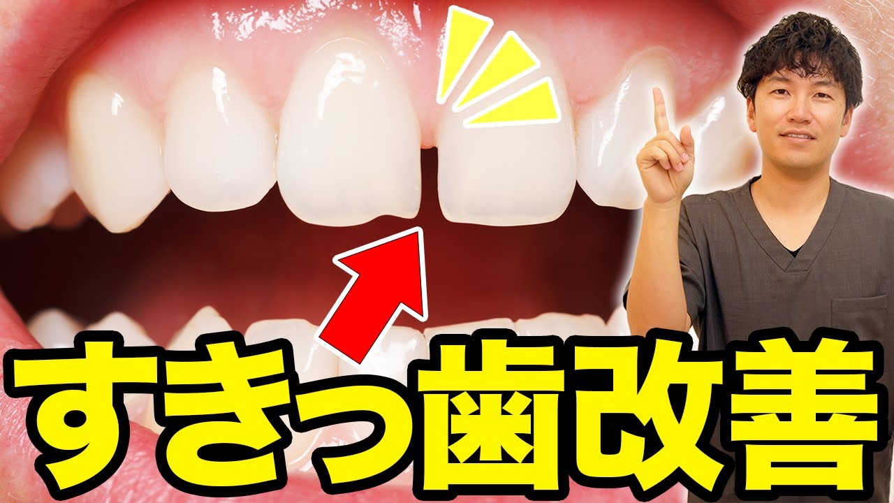 【すきっ歯改善方法】すきっ歯を放置していると大変なことに？すきっ歯の治し方を教えます！
