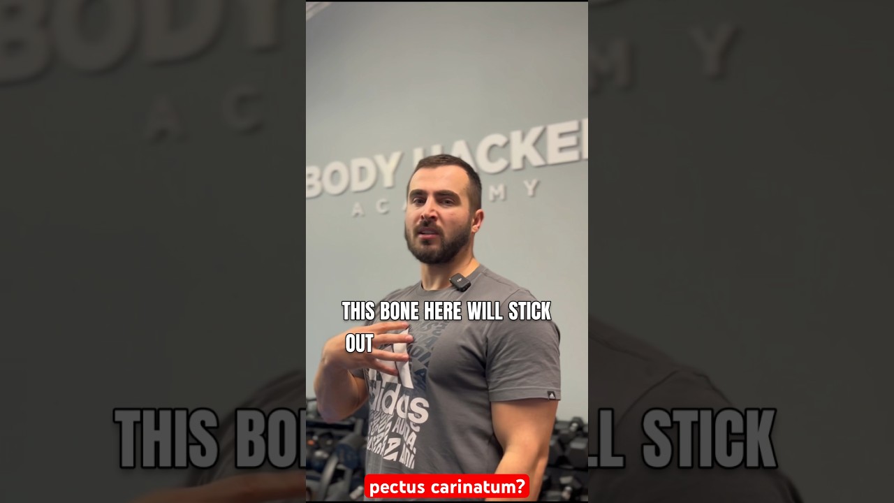 How I Fixed My Pectus Carinatum! #pectuscarinatum