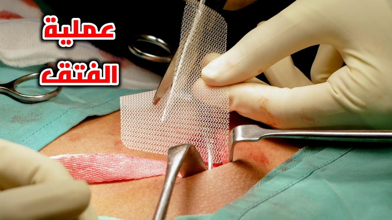 شاهد عمليه اصلاح الفتق بالجراحة والمنظار _ Hernia Surgery