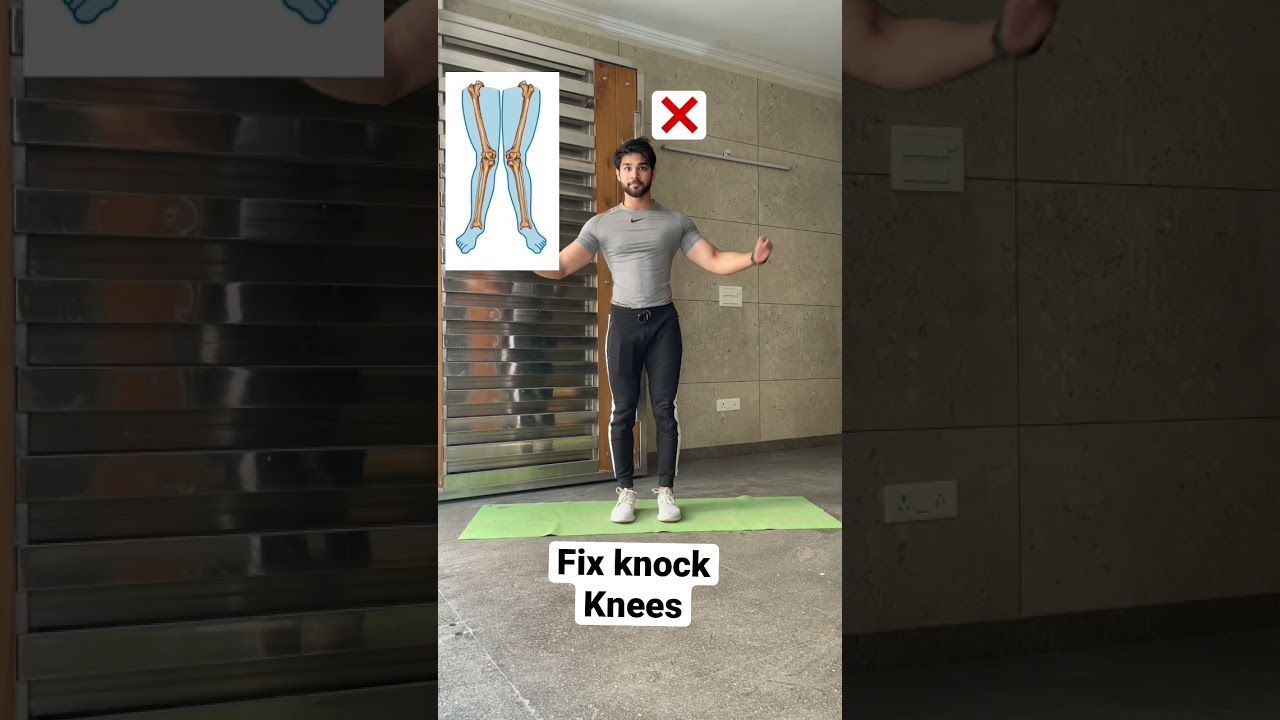 Knock knee Workout | Saurabh Fitness | #youtubeshorts #shorts