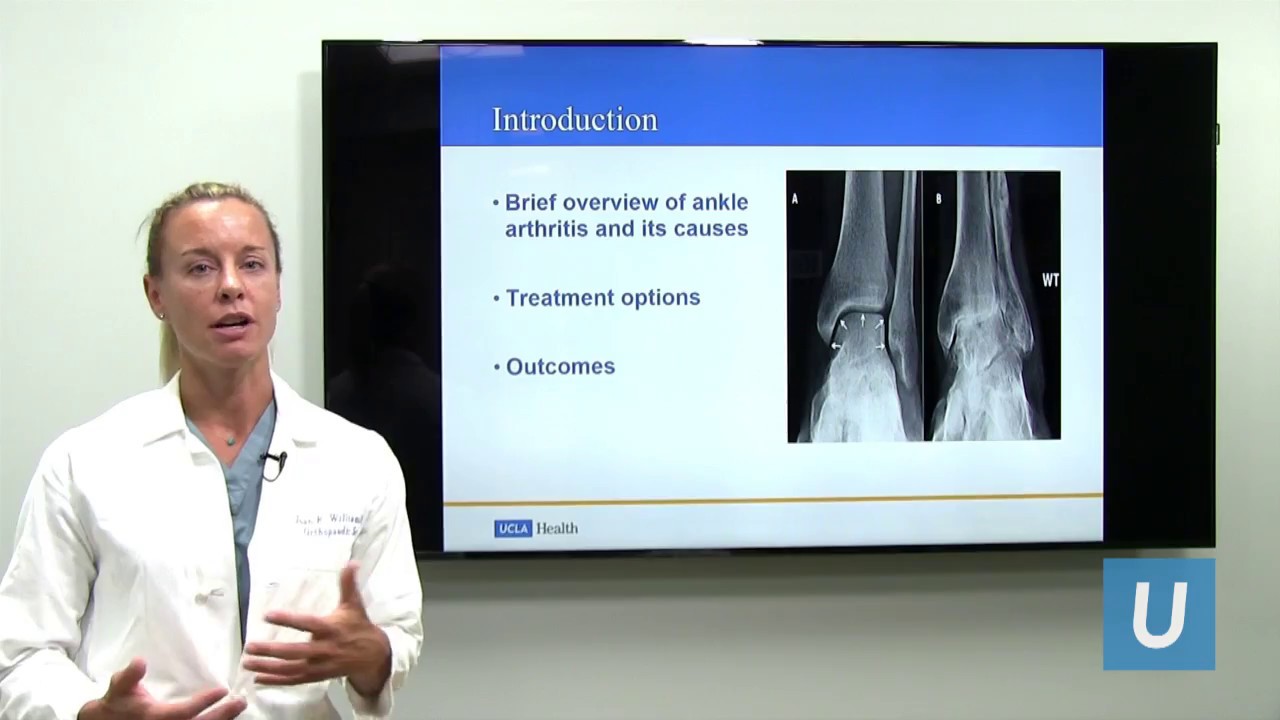 Ankle Arthritis | Joan Williams, MD | UCLAMDChat