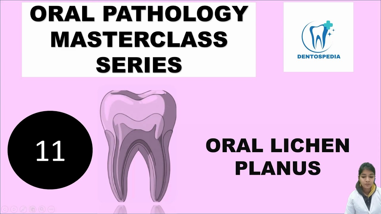 OP 11 Oral Lichen Planus Explained | Wickham Striae | Oral Pathology | #lichenplanus #oralpathology