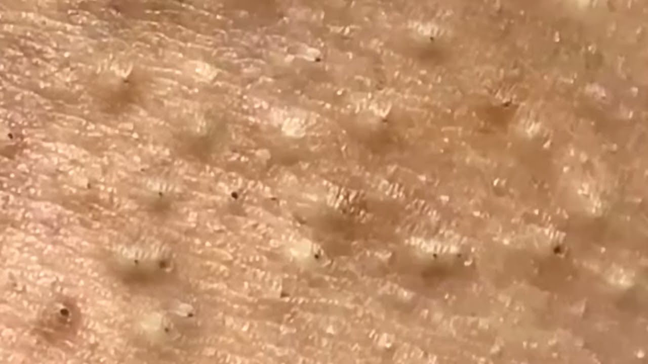 Blackheads & Whiteheads Satisfying Removal Acne and Pimple @08059