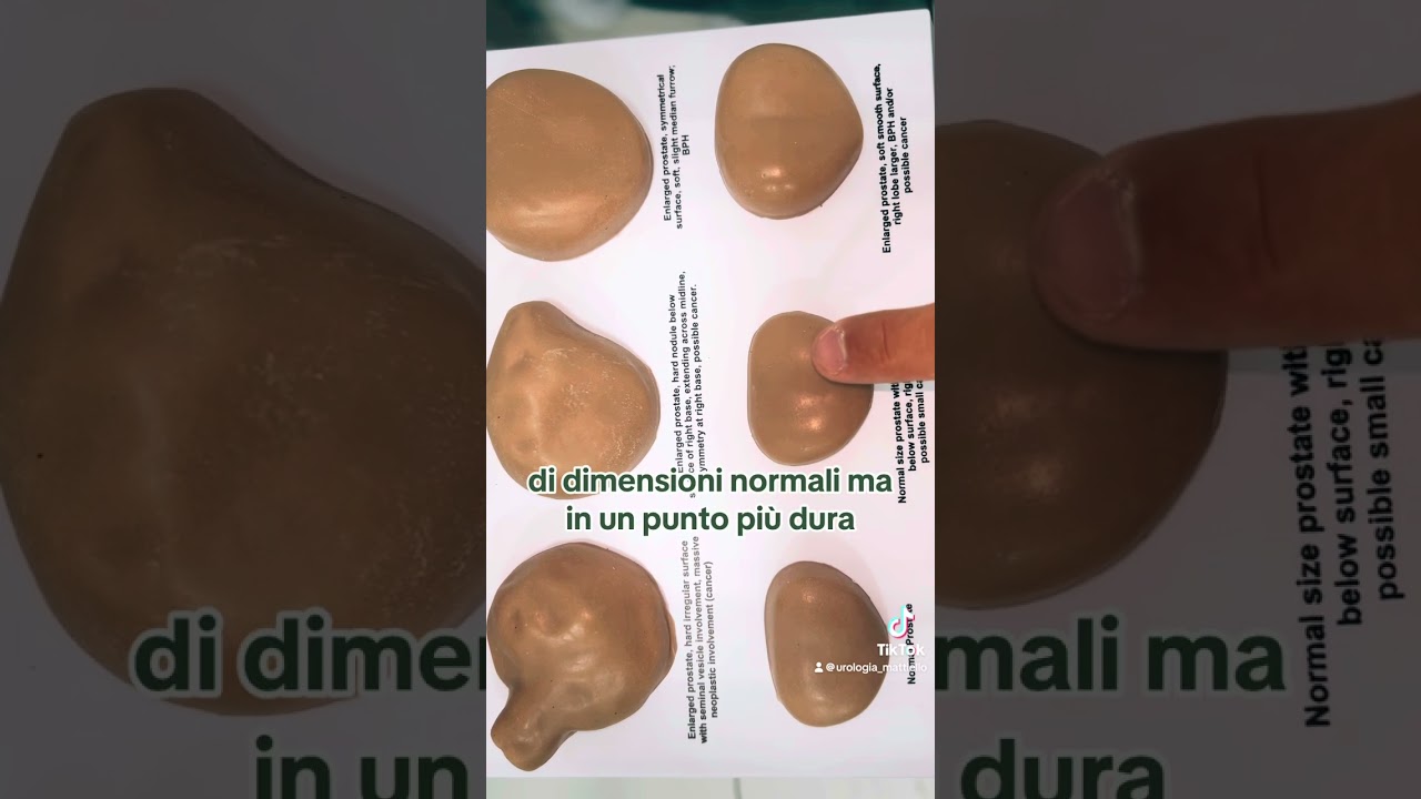Cosa sente l’urologo , durante l’esplorazione rettale