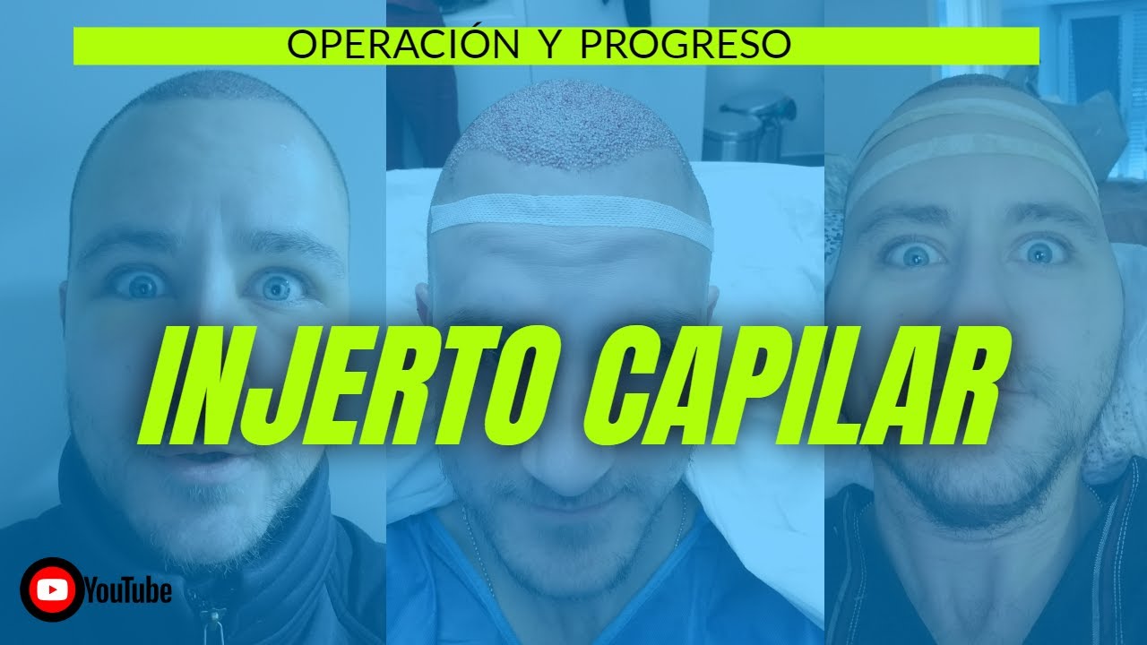 🏴‍☠ INJERTO CAPILAR en ESPAÑA | operación y  4 años de progreso | Clínica INSPARYA  🏴‍☠ QUIJADA 🏴‍☠
