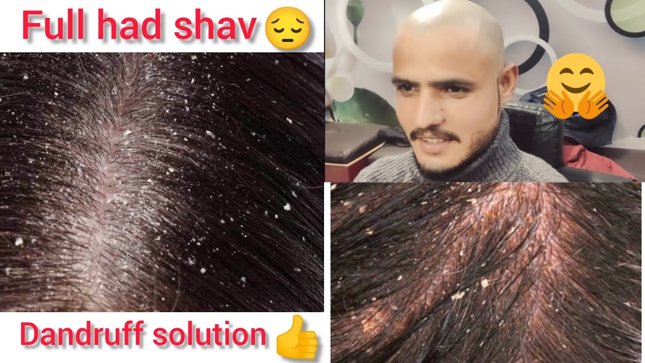 headshave ✂️/how to do dandruff😲 head shave/in Hindi)how to do head shave/dandruff removal head save