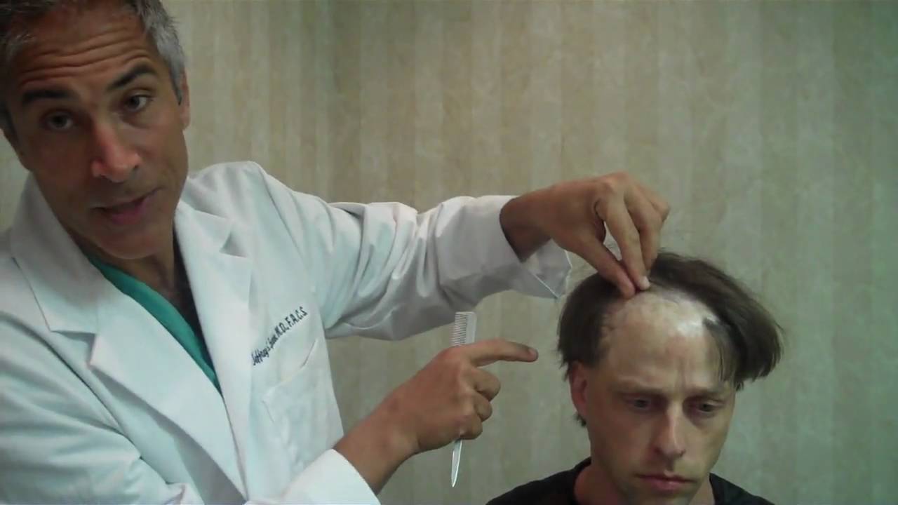 Plastic Surgeon Dr. Jeffrey S. Epstein - Scalp Burn Tissue Expansion / Hair Transplant Case