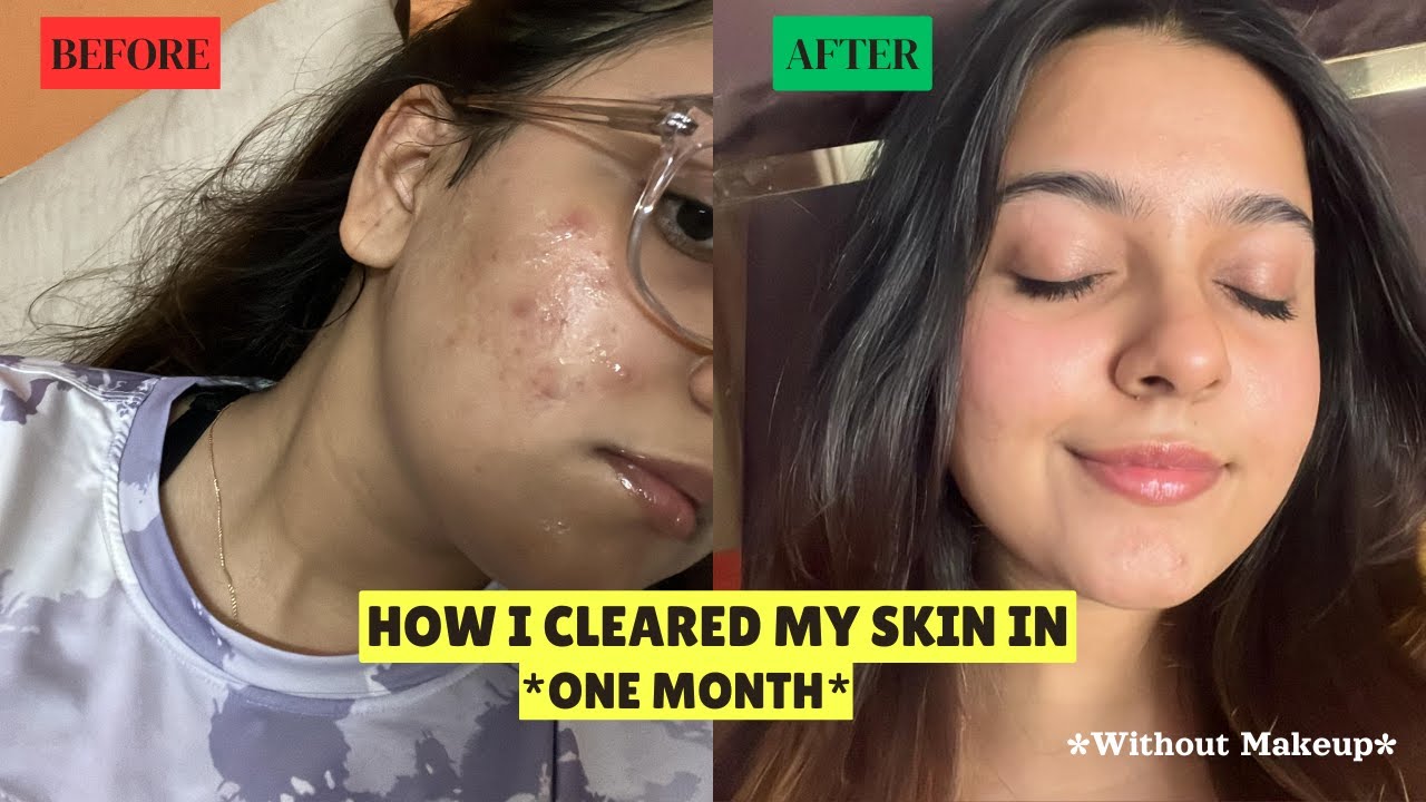 HOW I CLEARED MY ACNE IN JUST ONE MONTH *Simple & Effective* | Products that changed my life.