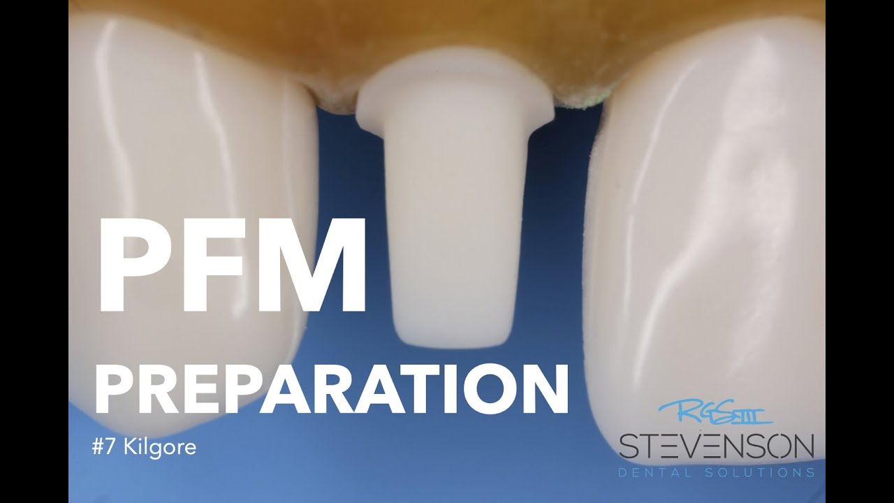 Препарирование PFM на зубе № 7, Килгор | Stevenson Dental Solutions