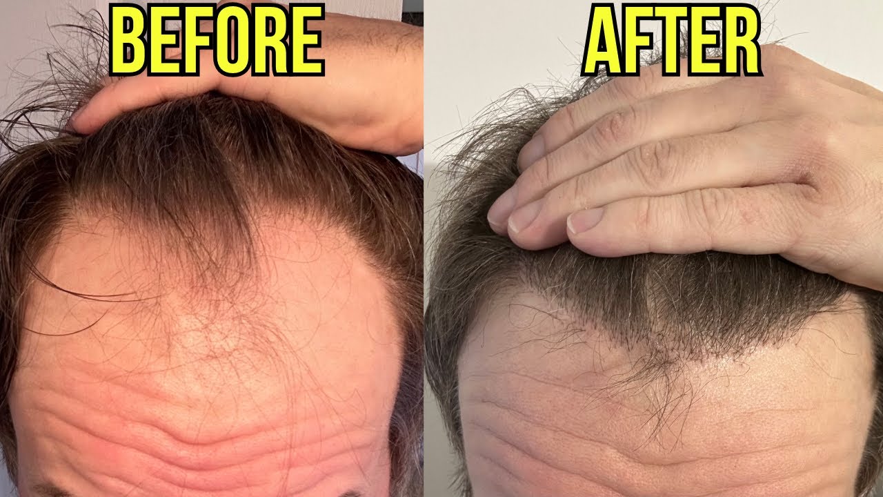 6 MONTH HAIR TRANSPLANT UPDATE AT MOTION CLINIC!!