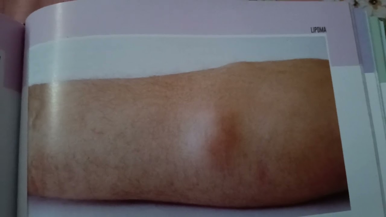 Lipoma गांठ
