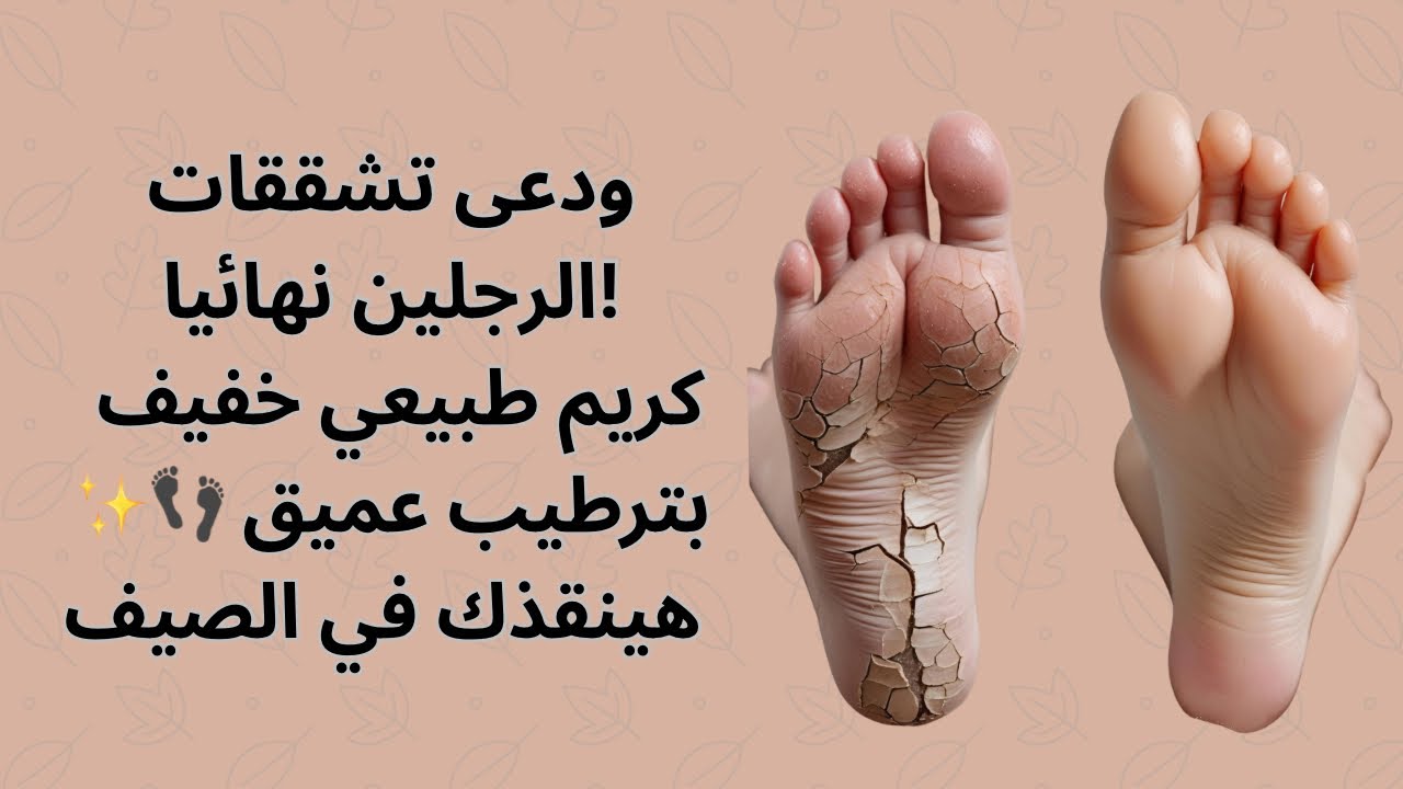 ودّعي تشققات الرجلين نهائيًا! كريم طبيعي خفيف بترطيب عميق 👣✨ هينقذك في الصيف