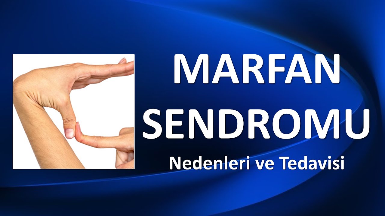 MARFAN SENDROMU NEDİR? NASIL TEDAVİ EDİLİR?