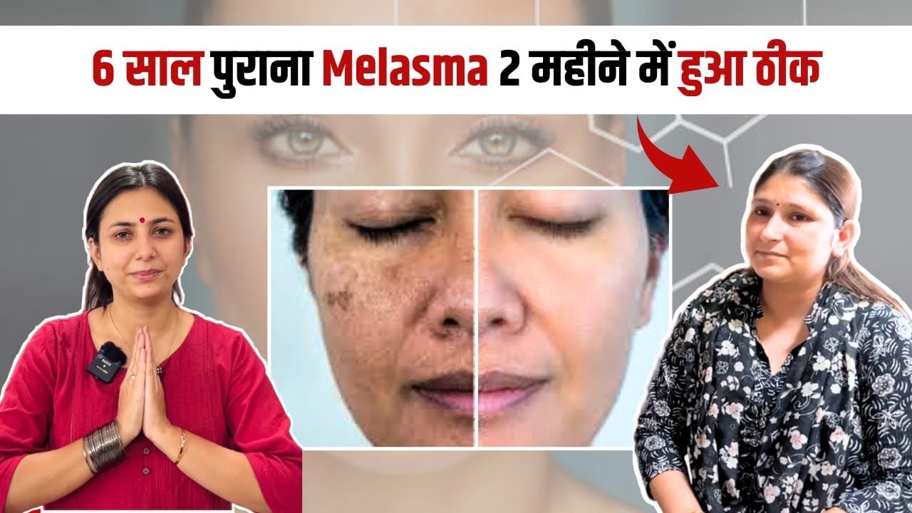 How to remove Hyperpigmentation naturally | Ayurvedic treatment Patient *Review* | Dr. Upasana Vohra
