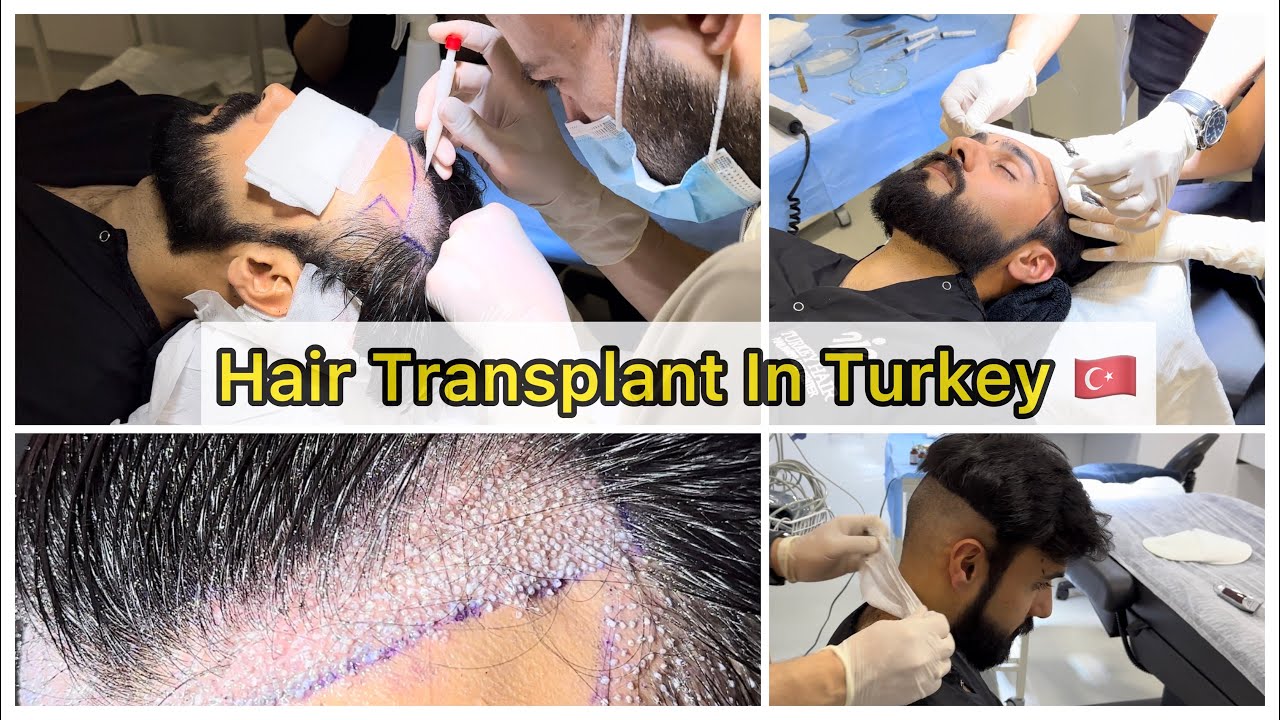 Waleed Ka Hair Transplant Ho Gaya | Cost? Time? Recovery? | Best Place In Turkey For Hair Transplant