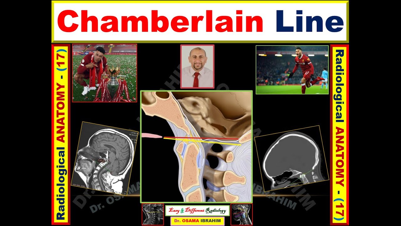 Chamberlain Line  Radiological Anatomy (Episode-17); Basilar Invagination
