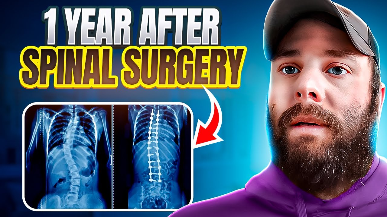 Navigating The Journey - 1 Year After Spinal Fusion - Milestone