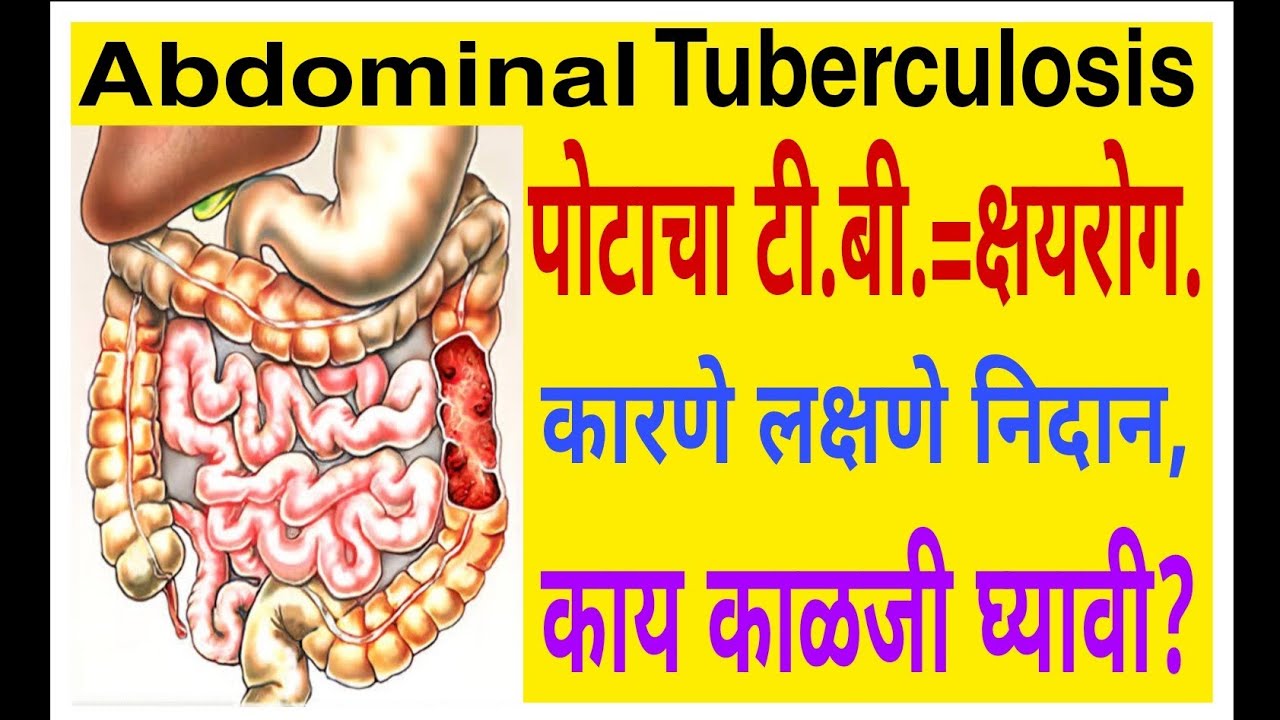 Abdominal Tuberculosis पोटाचा टी.बी.- क्षयरोग.कारणे लक्षणे,काय काळजी घ्यावी?/519/@drramjawale