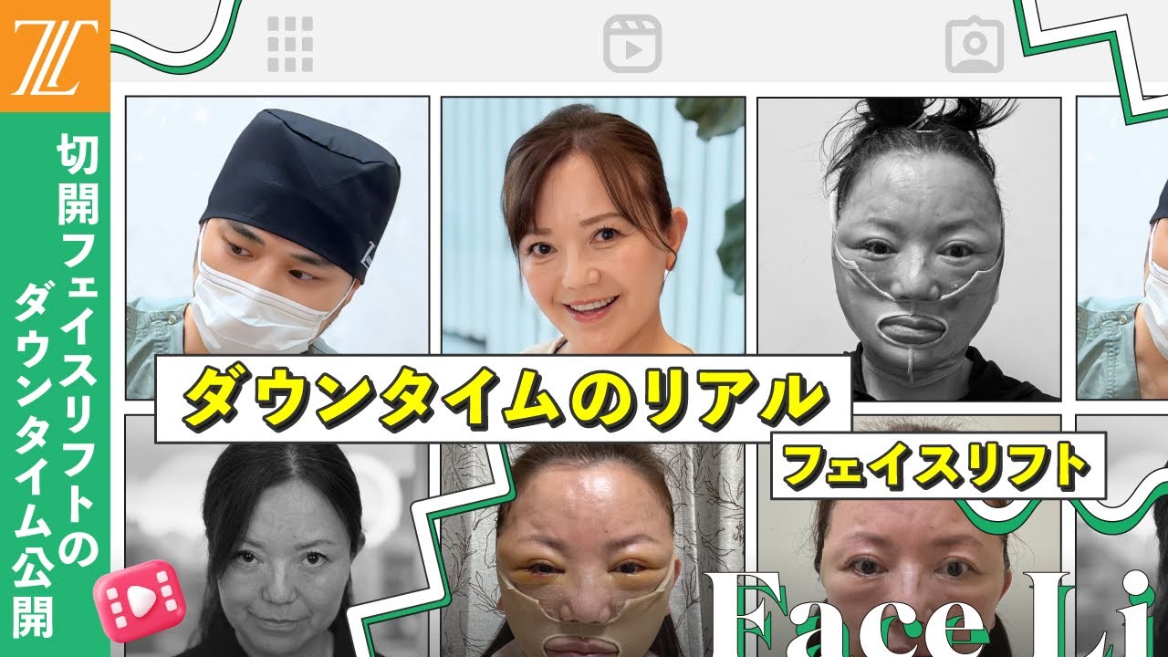 【ダウンタイム】術後翌日から1ヶ月までのリアルな変化と回復の全記録#若返り #ゼティス#フェイスリフト#フェイスリフト #切開フェイスリフト #切開リフト
