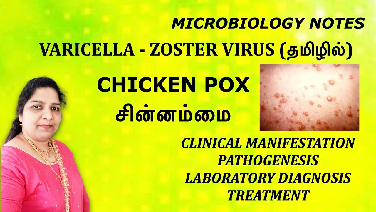 Varicella-Zoster virus / chicken pox/ Shingles / Pathogenesis / Lab diagnosis / Treatment / Tamil
