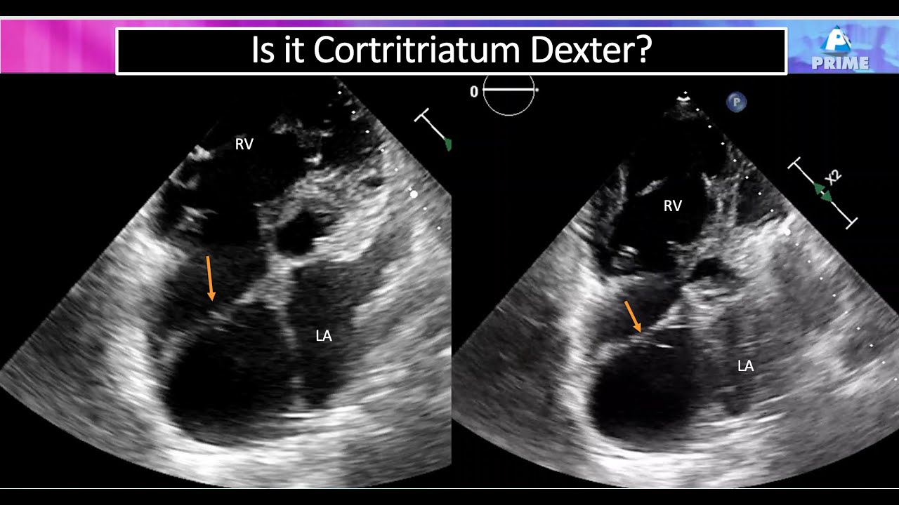 Cortriatriatum Dexter or normal Eustachian valve