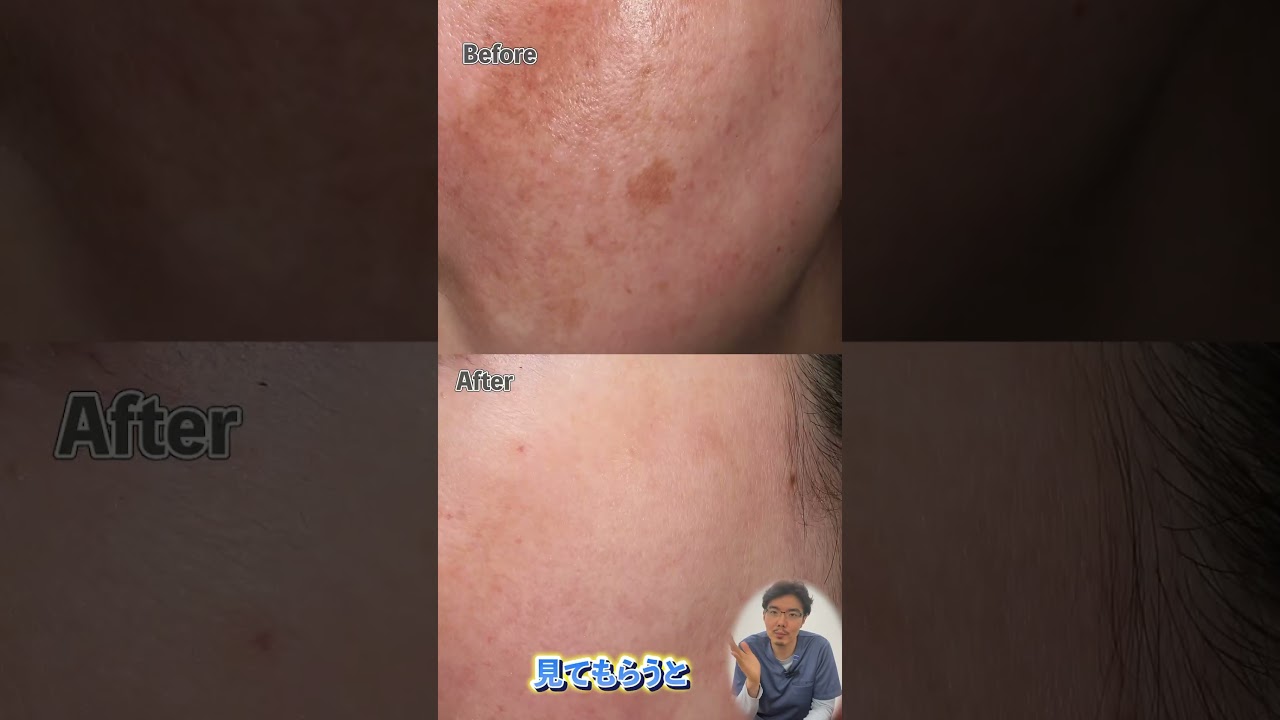 【教えて!!Dr.菅原】VISIAはこうやって使え!! #junclinic #visia＃菅原順