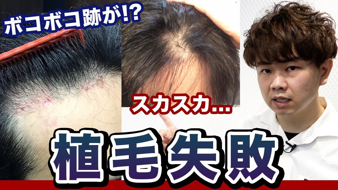 【植毛失敗】提供していただいた自毛植毛の失敗例をご紹介