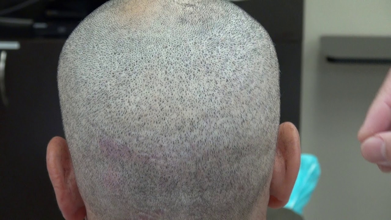 FUE Hair Transplant Donor Scars After Hair Transplant After 4 FUE Surgeries Minimal Scars