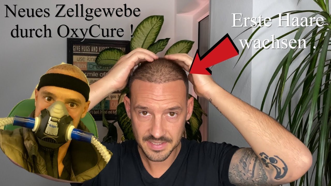 1 Monat nach der Haartransplantation Istanbul / OxyCurebehandlung bildet neue Zellen