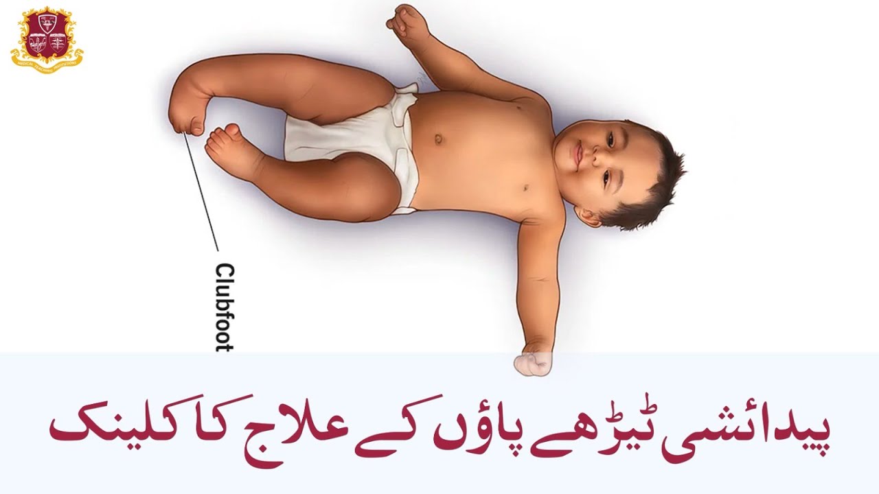 KP's First Free Clubfoot Clinic | Dr. Sikandar Hayat | Consultant Paediatrics Orthopaedic Surgeon