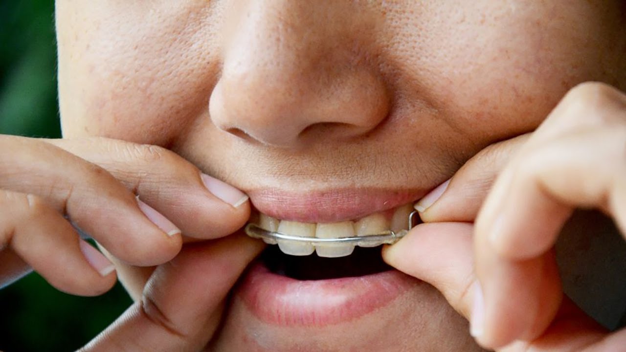 How Long Do I Have to Wear My Retainer and Why?
