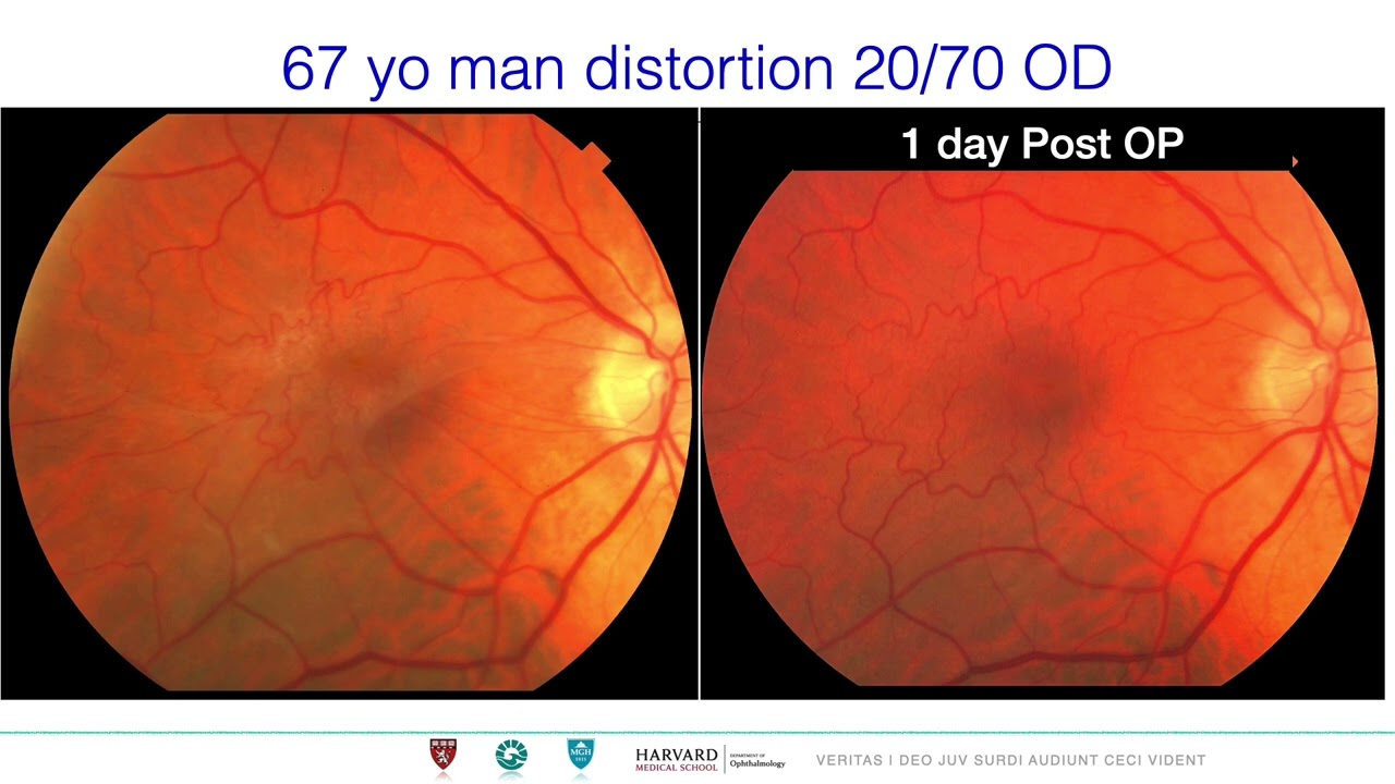 Epiretinal Membrane (ERM) Macular Pucker , epiretinal proliferation. Need for ILM peel ? Basics (HD)