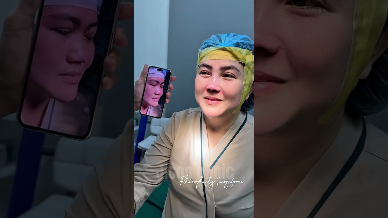 Natural rhinoplasty journey - Real customer feedback