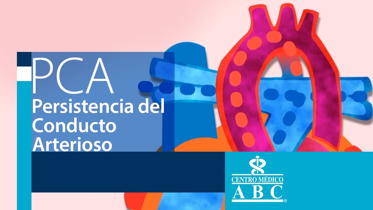 &iquest;Qu&eacute; es la persistencia del conducto arterioso (PCA)?